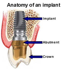 Anatomy of an Implant