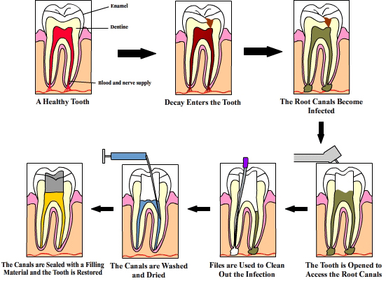 Root Canal Therapy Diagram