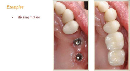 Examples of Missing Molars
