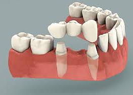 Southdown Dental has dental bridge and restorative solutions for you.